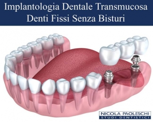 Implantologia Dentale Senza Bisturi Dr.Nicola Paoleschi