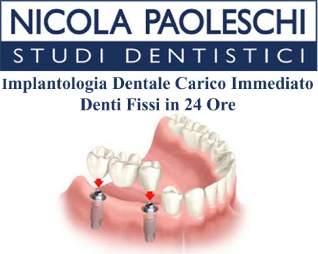 Implantologia Dentale Carico Immediato Pisa Dr. NICOLA PAOLESCHI
