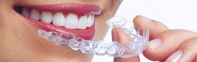 Bandaggio dentale estetico ed incognito Empoli. Andromeda Centro Odontoiatrico