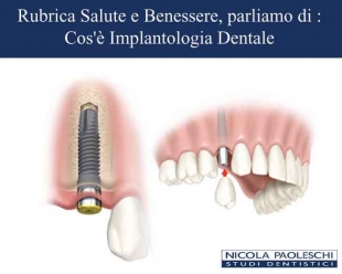 Implantologia dentale Sarzana Dr. Nicola Paoleschi