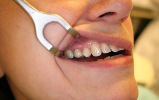 Ricostruzione denti con perno Empoli. Andromeda Centro Odontoiatrico