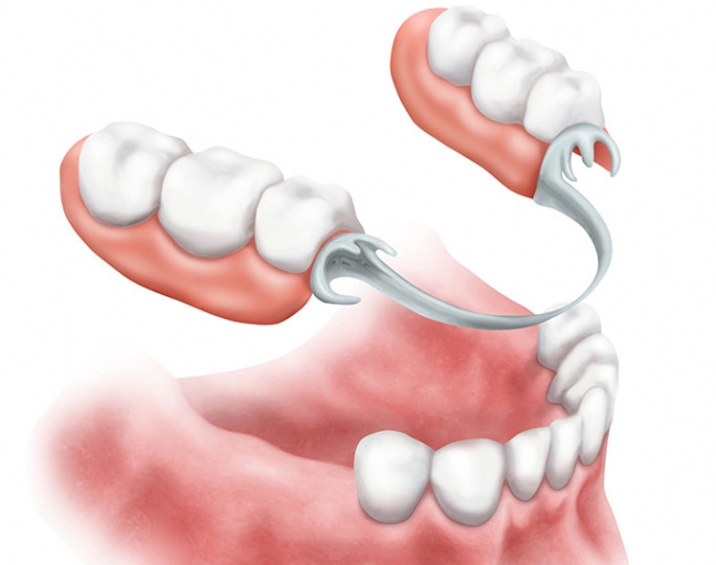 Protesi dentale scheletrata Empoli. Andromeda Centro Odontoiatrico