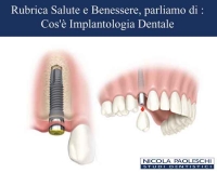 Rubrica Salute: Implantologia Dentale