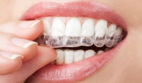 Bite dentale Empoli. Andromeda Centro Odontoiatrico