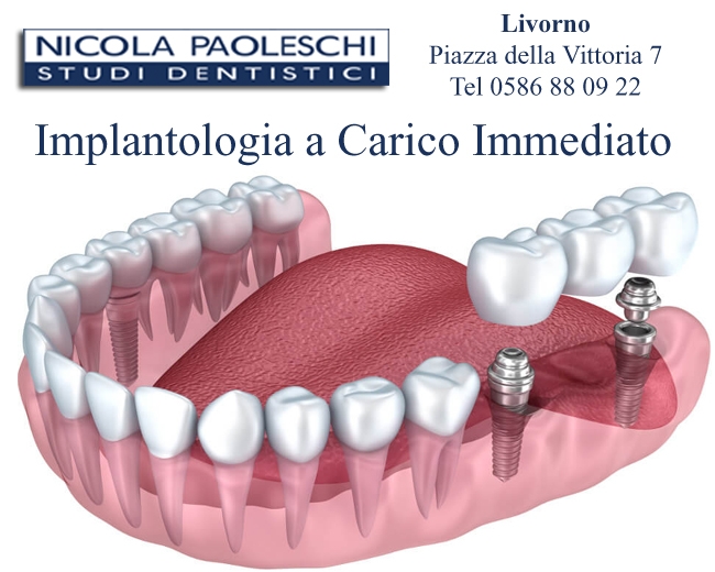 Implantologia dentale  a carico immediato prezzi LIVORNO