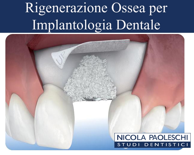 Rigenerazione Ossea Implantologia Firenze